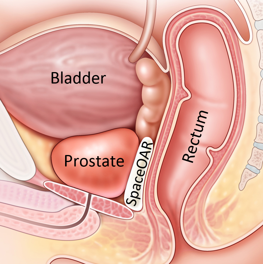 Prostate cancer in women