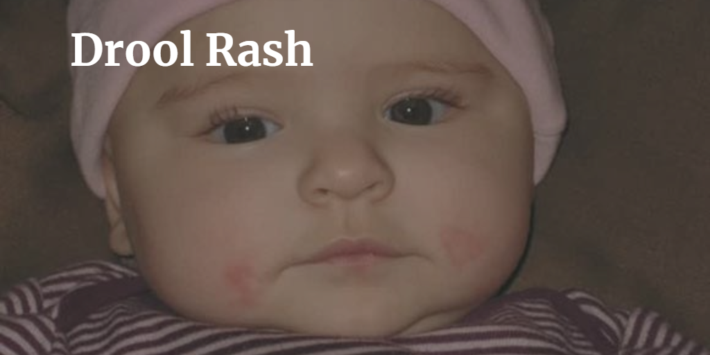 Drool Rash