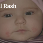 Drool Rash