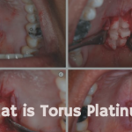 Torus Platinus