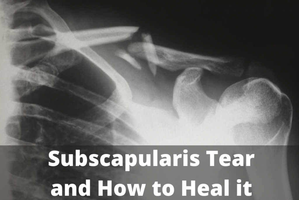 subscapularis tear