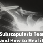 subscapularis tear