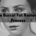 buccal fat removal