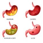Nexium vs Prevacid