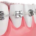 Overbite vs Underbite