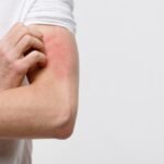 Allegra Hives Vs Allegra