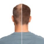 Propecia vs Finasteride