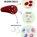 Understanding the Link Between Myelodysplastic Syndrome and Railroads