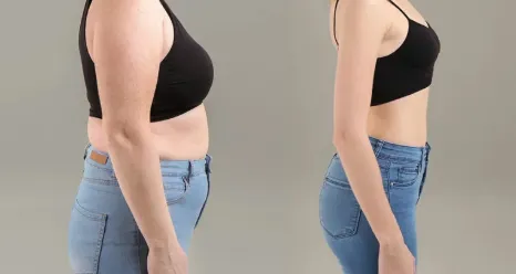 Semaglutide for Weight Loss